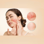 Gel pentru regenerării pielii, HERMO®Gel